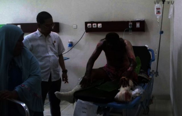 Korban kebakaran dan ledakan sumur minyak di Aceh Timur dalam perawatan di rumah sakit. (Foto/Muhammad Ishak)
